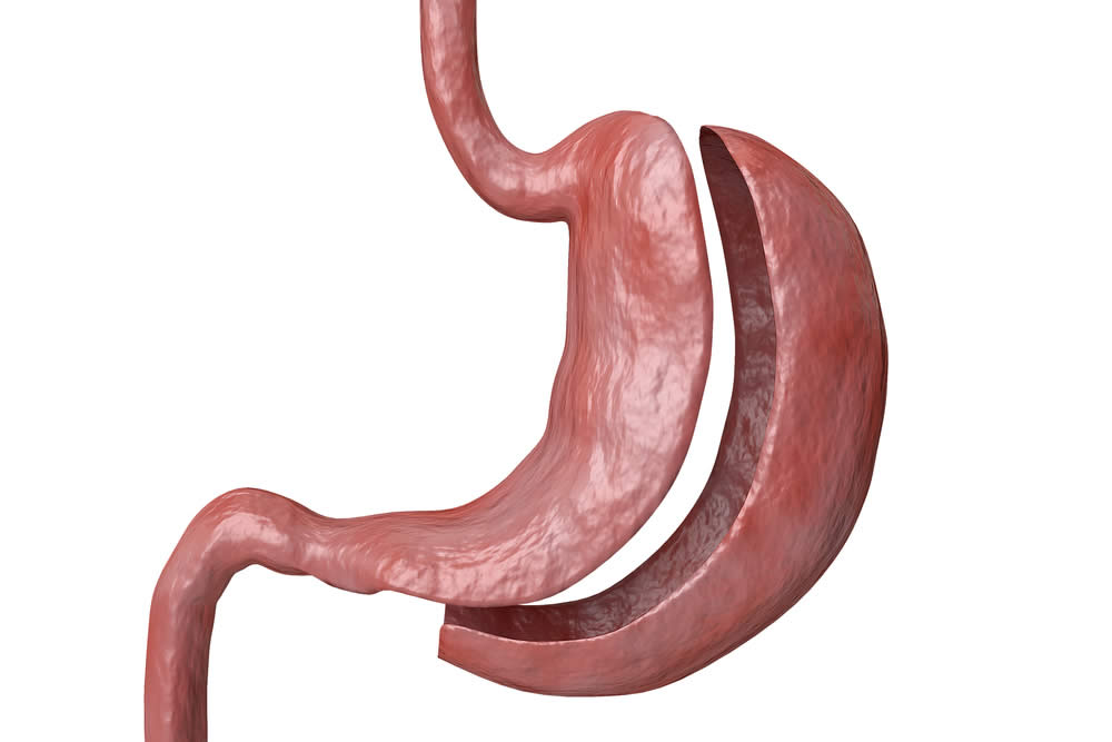 Sleeve Gastrectomy