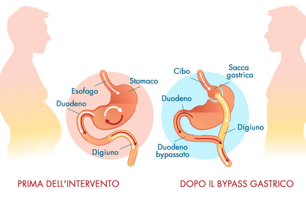 Bypass gastrico