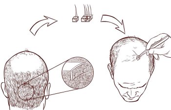 In questo articolo Parliamo della Tecnica FUT, l'intervento tradizionale con cui si realizza il trapianto di capelli. Vedremo insieme i vantaggi e gli svantaggi della procedura, come si esegue e in quali situazioni è indicata.