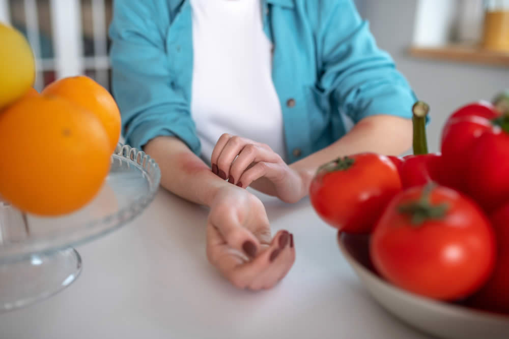 Dieta e Orticaria