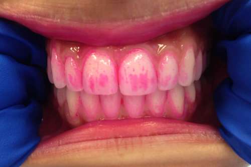 In questo articolo parliamo dei Rilevatori di Placca, analizzandone Utilità per una Migliore Igiene Orale, Tipologie e Principio di Funzionamento