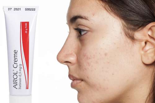 Recensione del Farmaco Airol Crema: Quando Fa bene? Quando Fa Male? Per Cosa si Usa? Dosi e Uso Corretto della Tretinoina topica contro Acne e Comedoni. Foglio Illustrativo Spiegato, Controindicazioni ed Effetti Collaterali