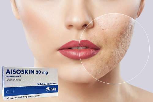 Recensione del Farmaco Aisoskin 10 mg e 20 mg Capsule: A Cosa Serve? Quando Fa bene? Quando Fa Male? Per Cosa si Usa? Dosi e Uso Corretto dell'isotretinonina contro l'Acne. Foglio Illustrativo Spiegato, Controindicazioni ed Effetti Collaterali