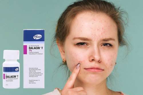 Recensione del Farmaco Gel, Emulsione e Soluzione Cutanea: A Cosa Serve? Quando Fa bene? Quando Fa Male? Per Cosa si Usa? Dosi e Uso Corretto della Clindamicina contro l'Acne. Foglio Illustrativo Spiegato, Controindicazioni ed Effetti Collaterali