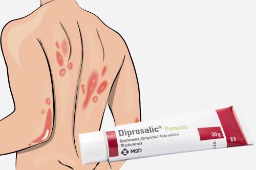 Recensione del Farmaco Diprosalic Unguento: Quando Fa bene? Quando Fa Male? Per Cosa si Usa? Dosi e Uso Corretto del Betametasone e dell'Acido Salicilico contro Eczemi e Psoriasi. Foglio Illustrativo Spiegato, Controindicazioni ed Effetti Collaterali