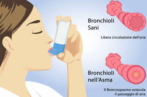 In questo articolo parliamo dell'Asma, delle sue Cause e dei Sintomi Associati. E' un Disturbo Grave? Quando Consultare il medico? Informazioni sulle Cure, i Farmaci e i Rimedi Efficaci per la Cura dell'Asma