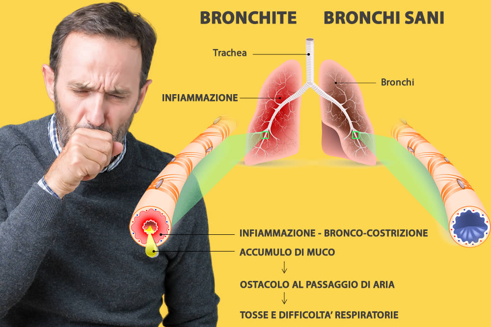 Bronchite