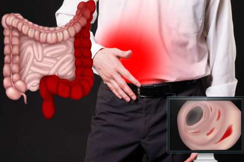 In questo articolo parliamo della Colite Ulcerosa, delle sue Cause e dei Sintomi Associati. E' un Disturbo Grave? Quando Consultare il medico? Esami per la Diagnosi, Informazioni sulle Cure e i Rimedi Efficaci per la Cura della Colite Ulcerosa