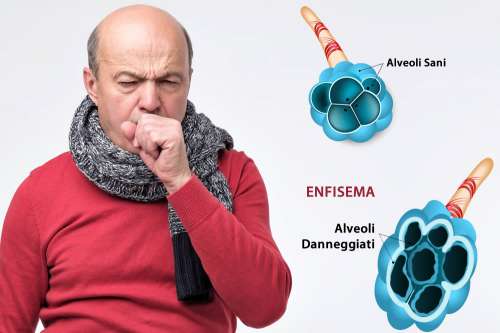 In questo articolo parliamo dell'Enfisema Polmonare, delle sue Cause e dei Sintomi Associati. E' un Disturbo Grave? Quando Consultare il medico? Informazioni sulle Cure, i Farmaci e i Rimedi Efficaci per la Cura dell'Enfisema Polmonare