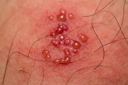 In questo articolo rispondiamo alle domande dei lettori riguardanti la contagiosità dell'Herpes Zoster, spiegando quando la malattia può essere pericolosa per chi non ha mai contratto la varicella, come si trasmette e come prevenire il contagio