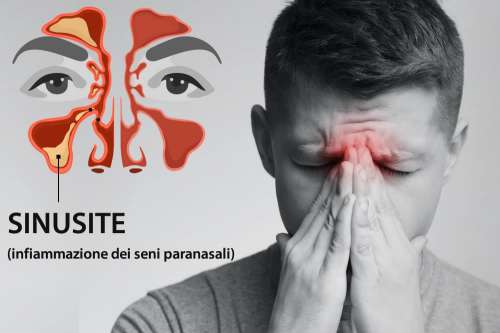 In questo articolo parliamo della Sinusite, delle sue Cause e dei Sintomi Associati. E' un Disturbo Grave? Quando Consultare il medico? Informazioni sugli Esami, le Cure, i Farmaci e i Rimedi Efficaci per la Cura della Sinusite