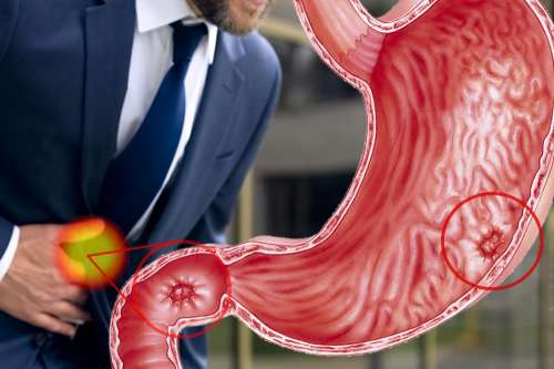 In questo articolo parliamo dell'Ulcera dello Stomaco, delle sue Cause e dei suoi Sintomi. Quando Consultare il medico? Quali Esami per la Diagnosi? Informazioni sulle Cure e i Rimedi più efficaci per la Cura dell'Ulcera Gastrica